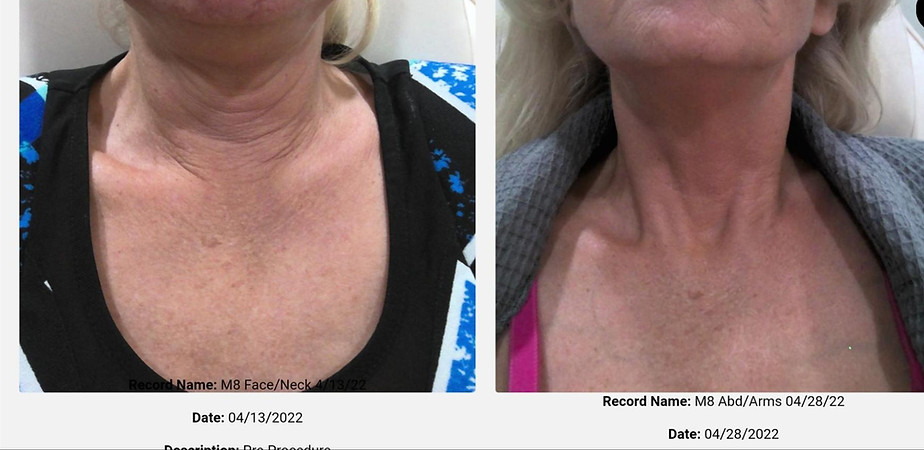 Morpheus 8 before/after images at Nouveau Dermé in Myrtle Beach, SC