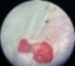 Reversão de vasectomia com microcirurgia: vasovasostomia e vasoepididimostomia para restaurar fertilidade masculina
