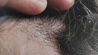 detalle-de-problematica-caspa.jpeg