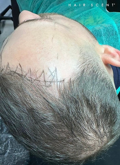 Tricopigmentazione a Potenza
