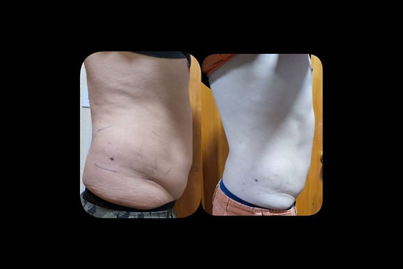 EXILIS 360 Body treatment by Area