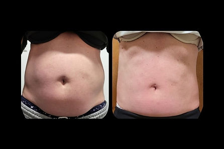CELLULITE BODY SIX SESSION PACKAGE