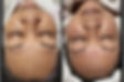 BB GLOW NANO MICRONEEDLES