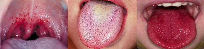 petéquias no pálato mole, língua saburosa e língua em framboesa em paciente com escarlatina