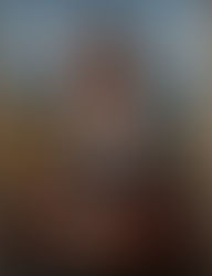                            Rinoplastía (Naríz)