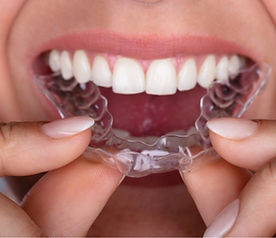 Gouttieres d'alignement strasbourg Orthodontie neudorf orthodontie strasbourg aligneurs strasbourg