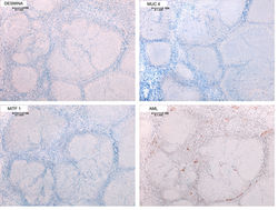 Desmina, MUC 4 / MITF 1, AML