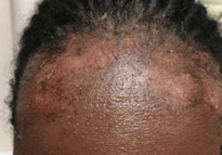 Seborrheic Dermatitis