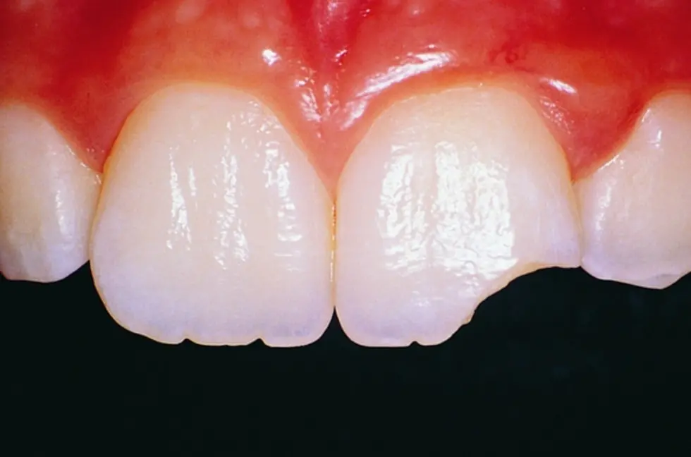 A chipped front tooth that needed emergency treatment