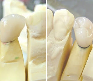 How A Dental Crown Is Made