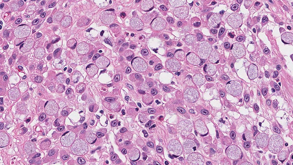 роль мембран в патологии клетки. порочный круг в повреждении клетки. клеточные патологии. клеточные патологии. патология клетки.
