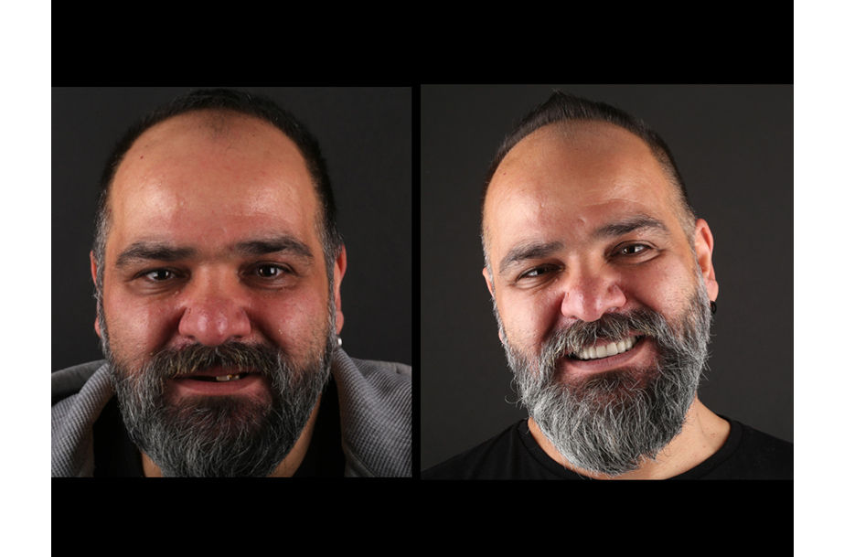 Ümit implant 10.jpg