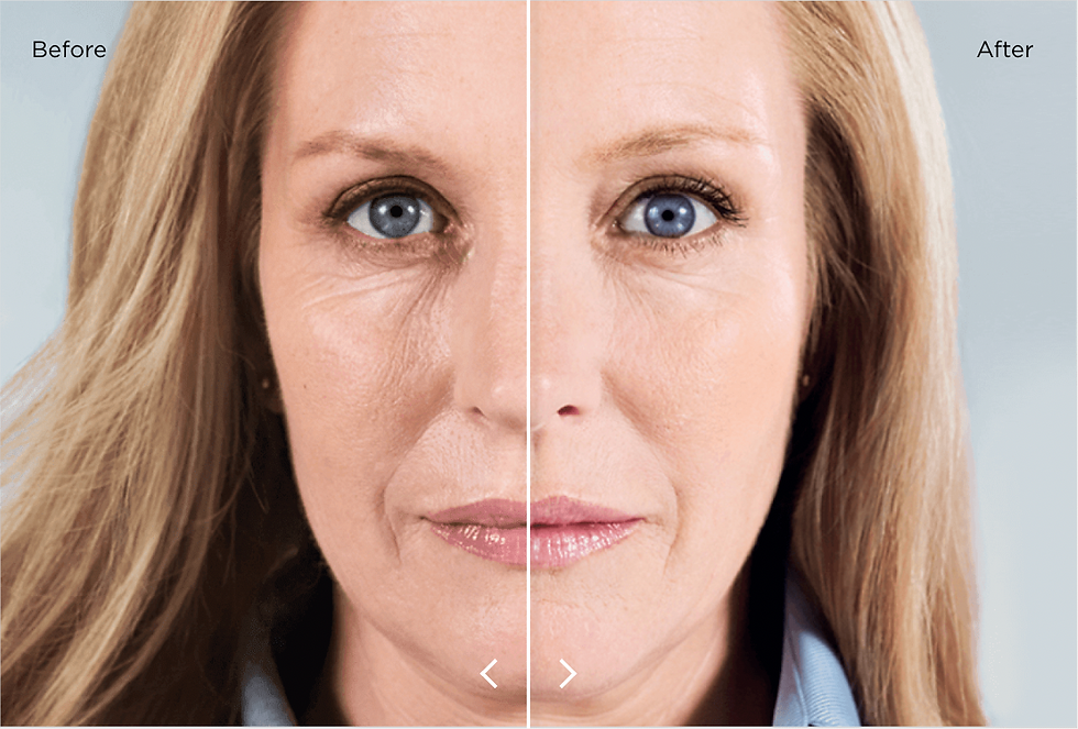Sculptra Treatment Before & After 5 months. *Individual results may vary.