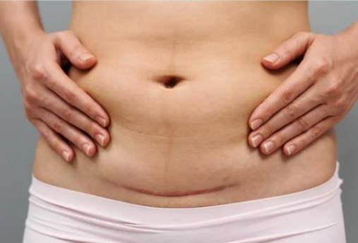 C-section scar