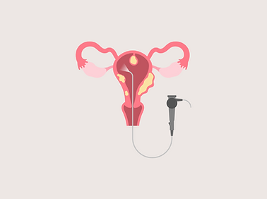 hysteroscopy