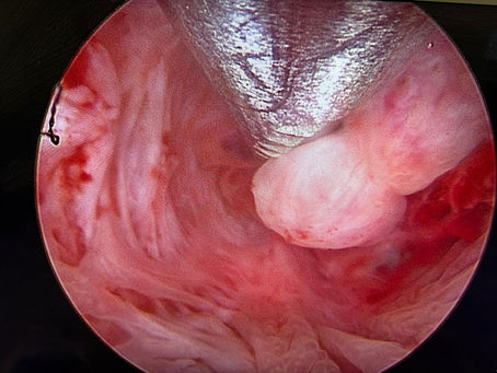 inside the uterus during hysteroscopy. it showed mass inside the uterus.