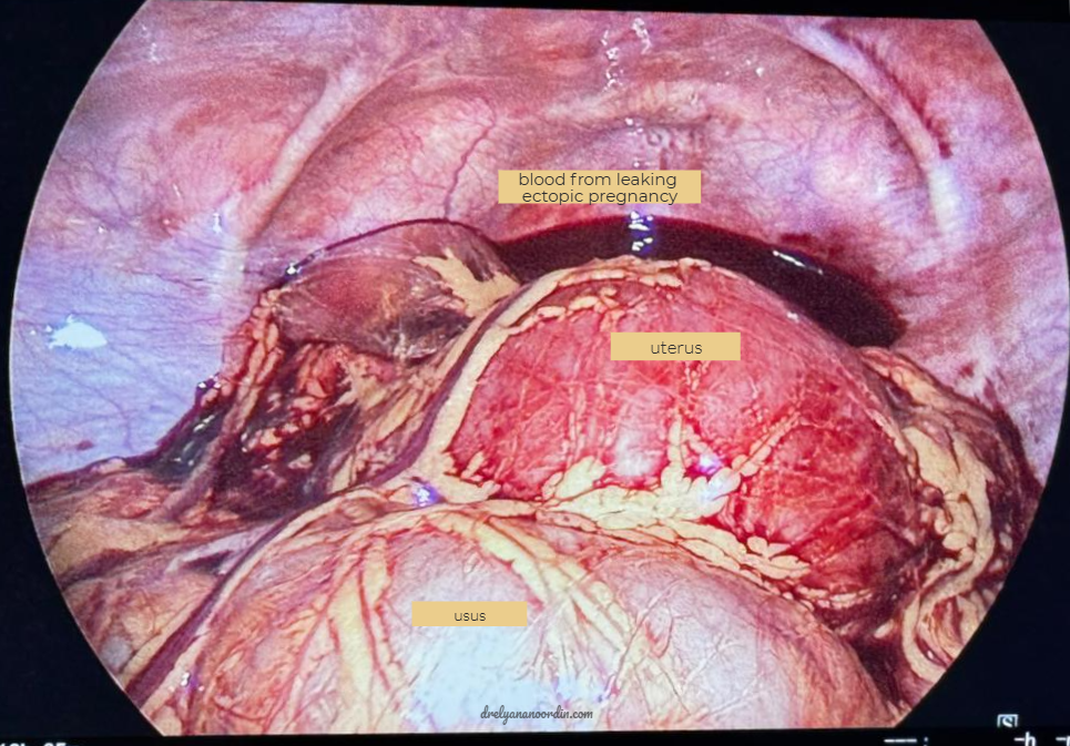 haemoperitoneum surrounding the uterus. Pendarahan di sekeliling rahim. ectopic pregnancy