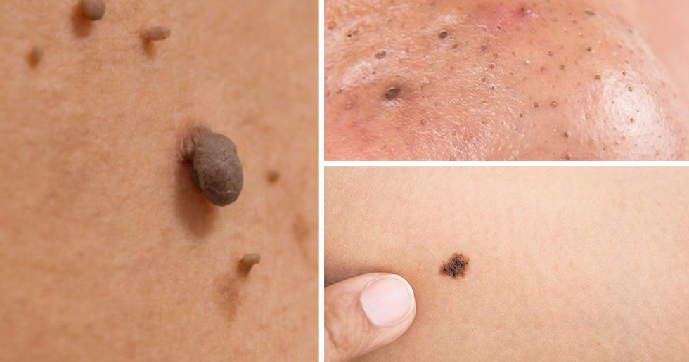 WARTS & MOLES