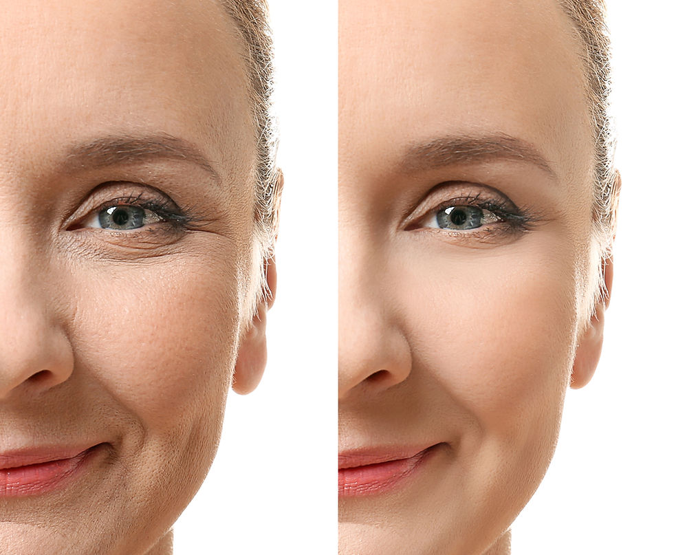 BOTOX