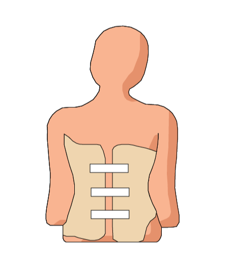 Scoliose brace
