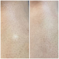 Before and after Camouflage tattoo, shows how flat white scars can be blended in seamlessly with the surounding skin tone