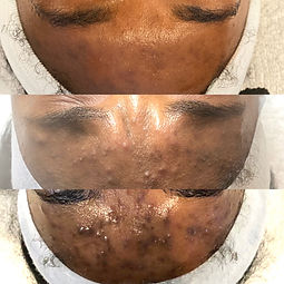 Black Esthetician performing chemical peels to treat acne scarring, hyperpigmentation,