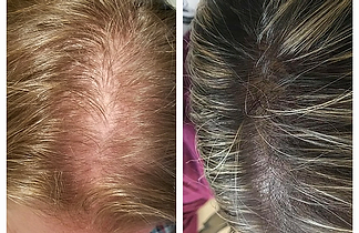 Scalp Micropigmentation img 2