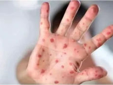 उत्तराखंड में टोमेटो फ्लू का खतरा, बच्चों में दिख रहे ये लक्षण, जानिए क्या करें