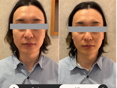 「小顔矯正=痛い」はもう古い?むくみ・たるみを根本から整える“優しい小顔整体”とは