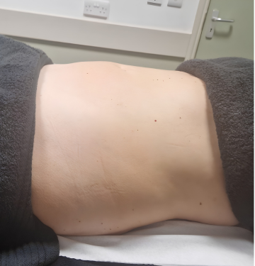Post-Op Lymphatic Drainage Before.png