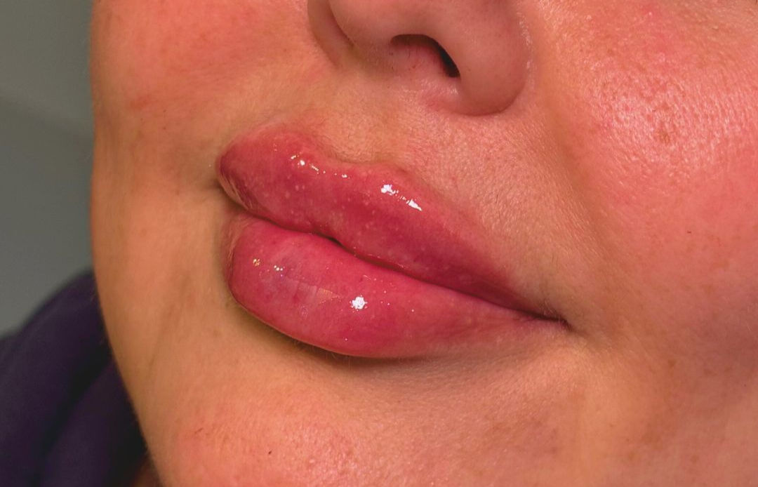 Online - Lip Filler Master Class