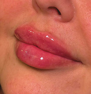 lip filler photo_edited.jpg