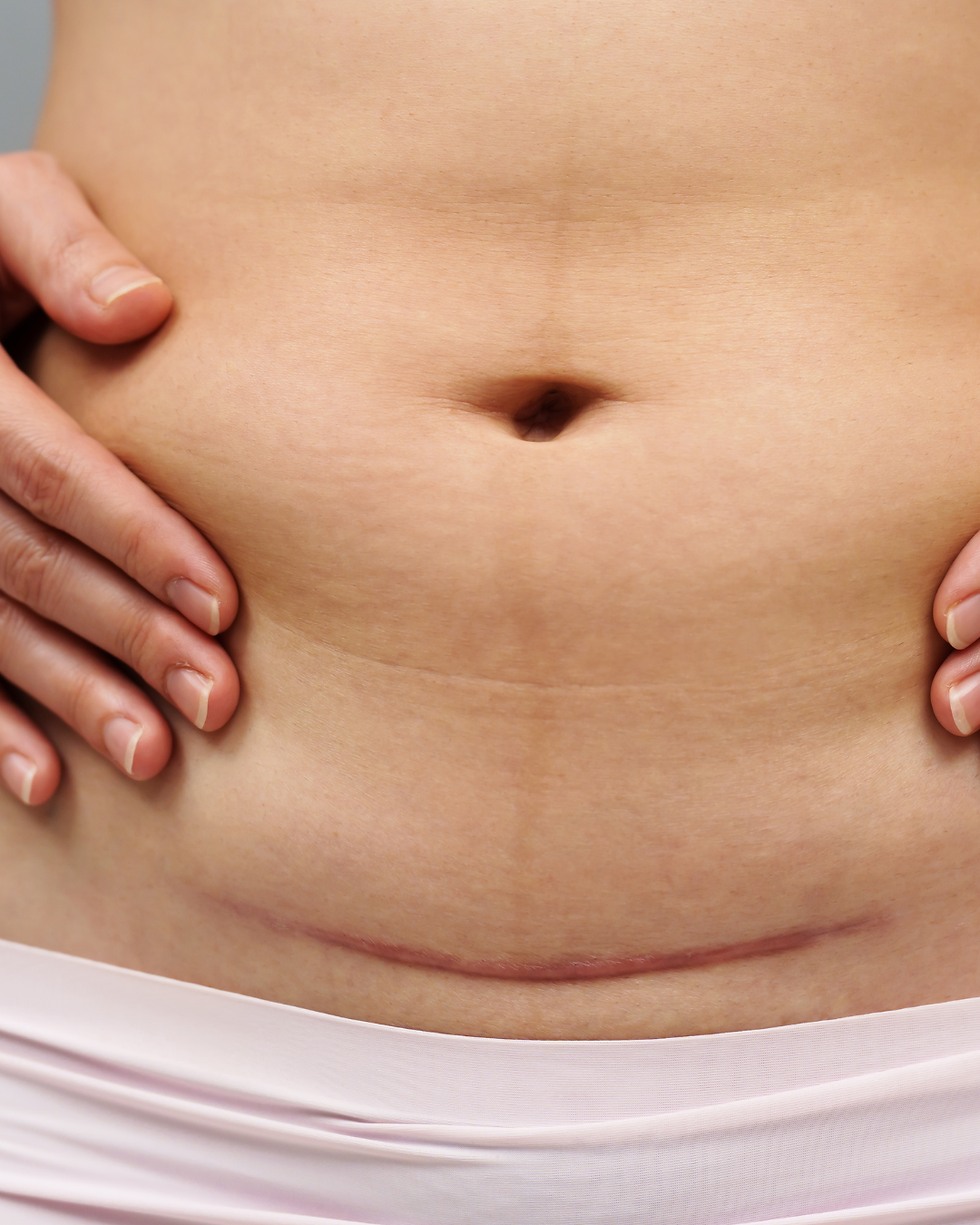 C-section scar