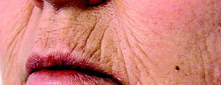 Micro Laser Peel Treatment Before Picture