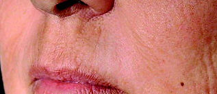 Micro Laser Peel Treatment After Picture