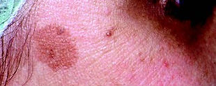 Micro Laser Peel Treatment Before Picture