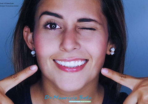 diseño de sonrisa