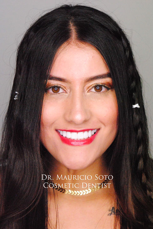 diseño de sonrisa