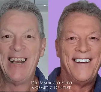 Porcelain Veneers before and after