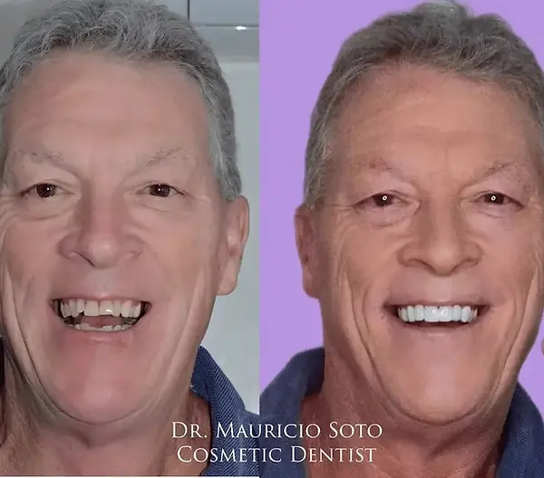 Full smile makeover results with 20 porcelain veneers in Bucaramanga