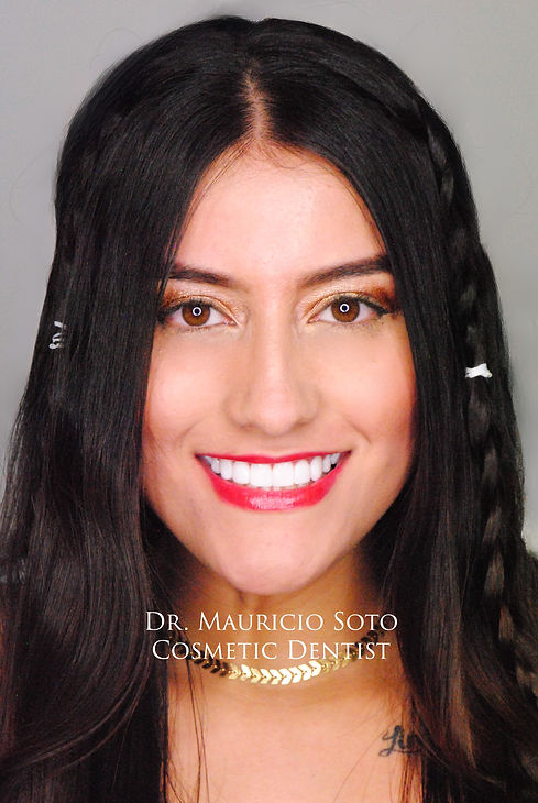 Veneers Porcelain