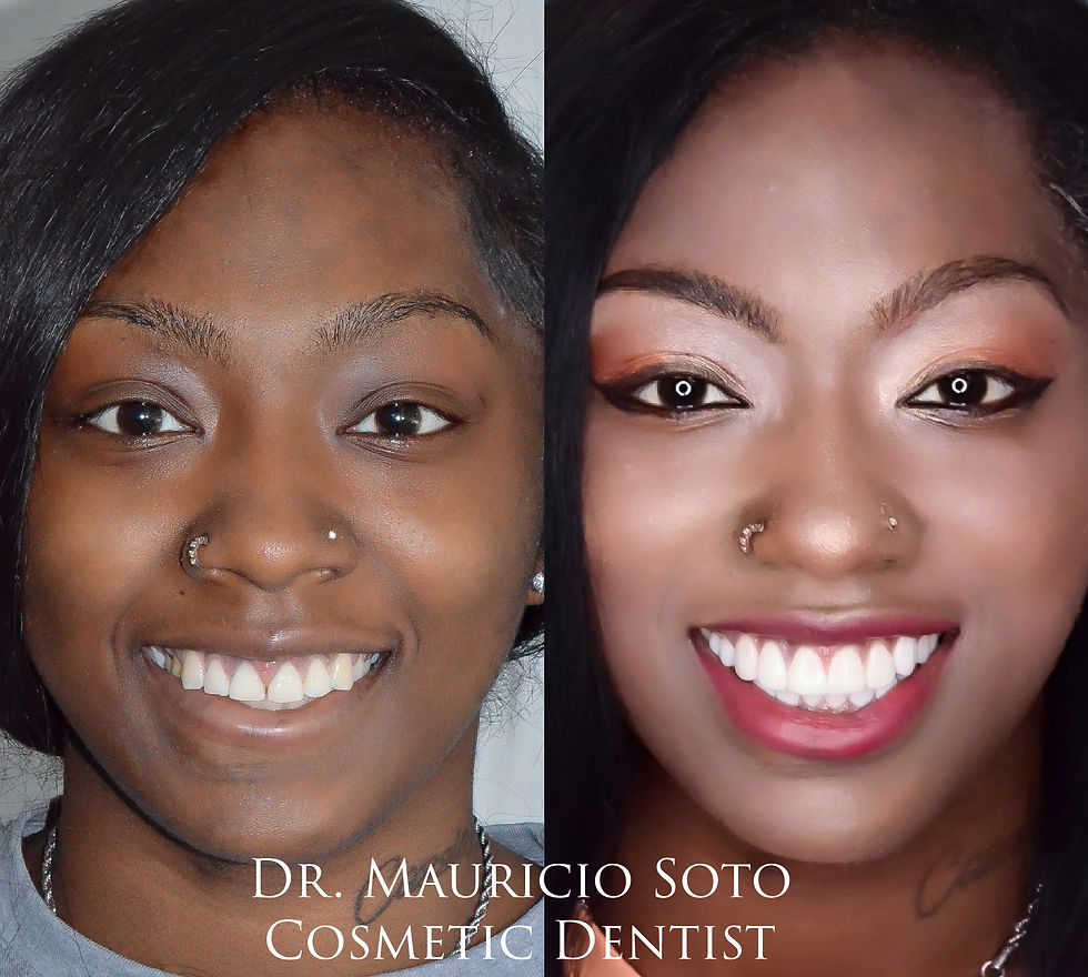 dental veneers