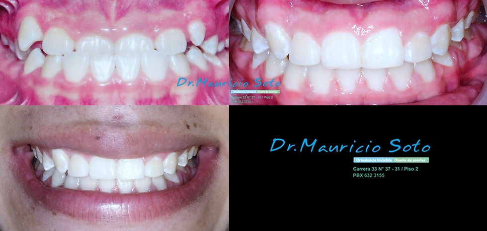 Ortodoncia Bucaramanga realizada por mauricio soto