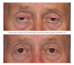 Before and after ptosis repair surgery.  