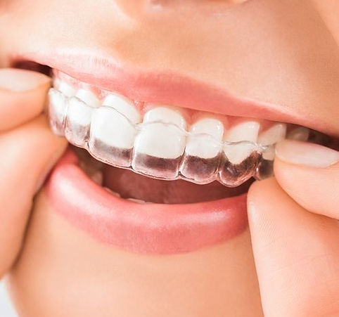 invisalign.jpg