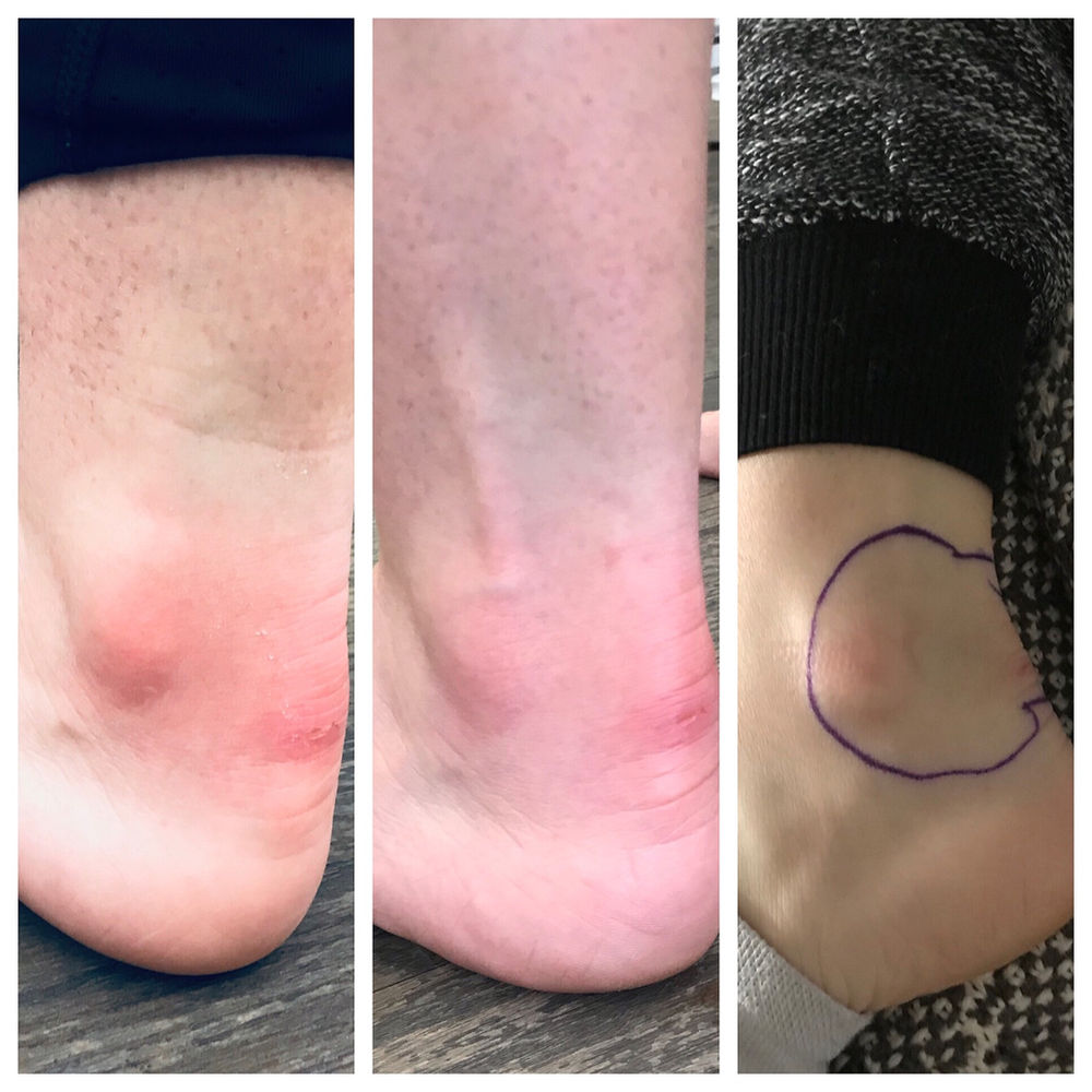 Acupuncture Treatment of Skin Infection