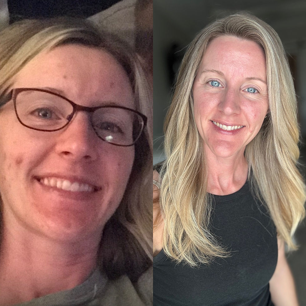 Cystic hormonal acne