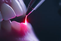 Laser Dentistry in Kompally