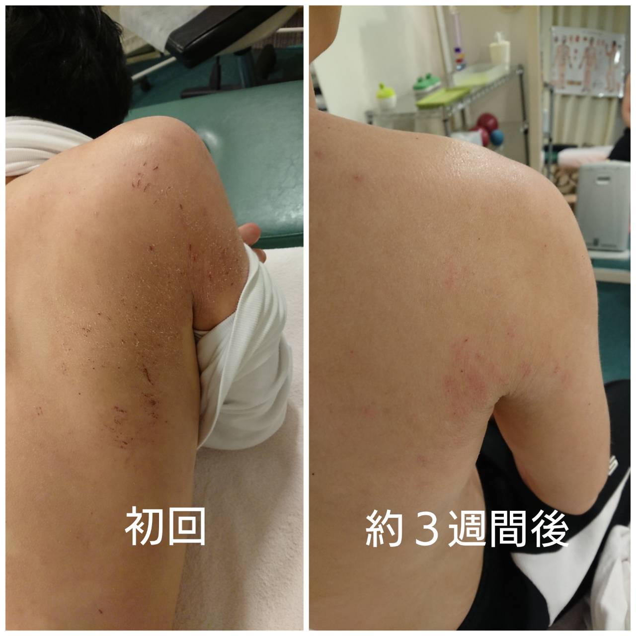 アトピー改善 約3週間後