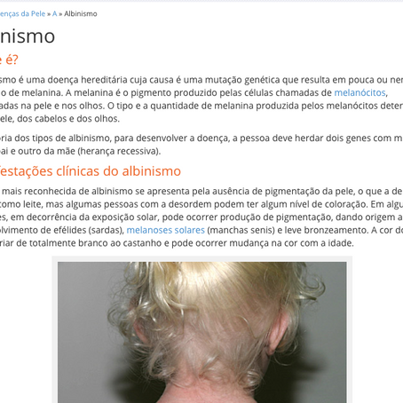 Dermatologia.net | Albinismo